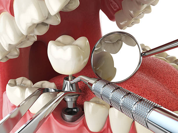 Urgent Tooth Repair in TN