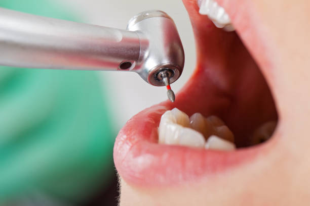 Best Dentist for Tooth Abscess  in Bristol, TN
